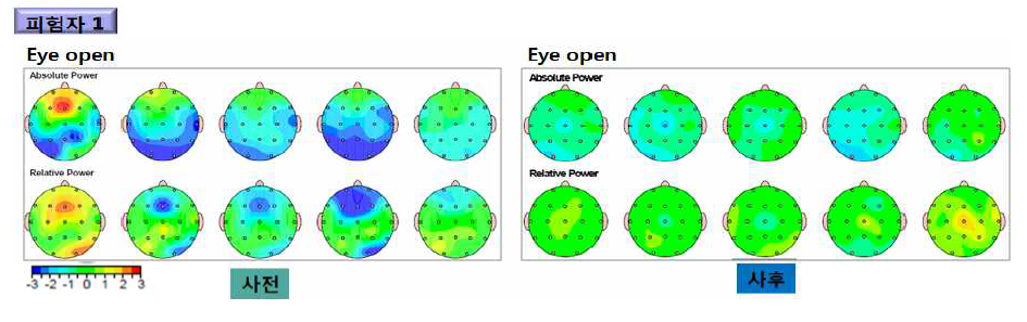 도박장애 환자의 사전 및 사후 검사 시 정량뇌파(QEEG) 분석 결과 (피험자 1의 사례 예)