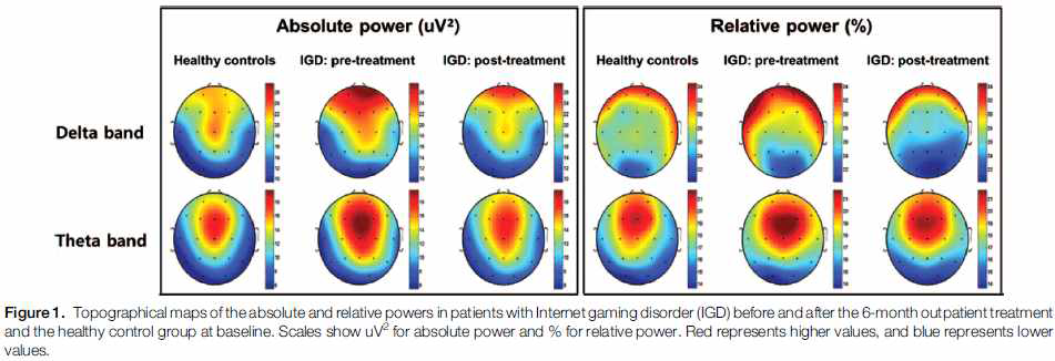 인터넷 게임 중독군의 치료전후 뇌파의 absolute and relative power 비교