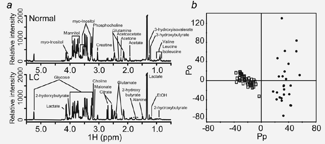 (a) 정상군과 Leptomeningeal carcinomatosis 환자군의 NMR profile과 주요한 peak 확인 (b) NMR 데이터의 OPLS-DA 모델