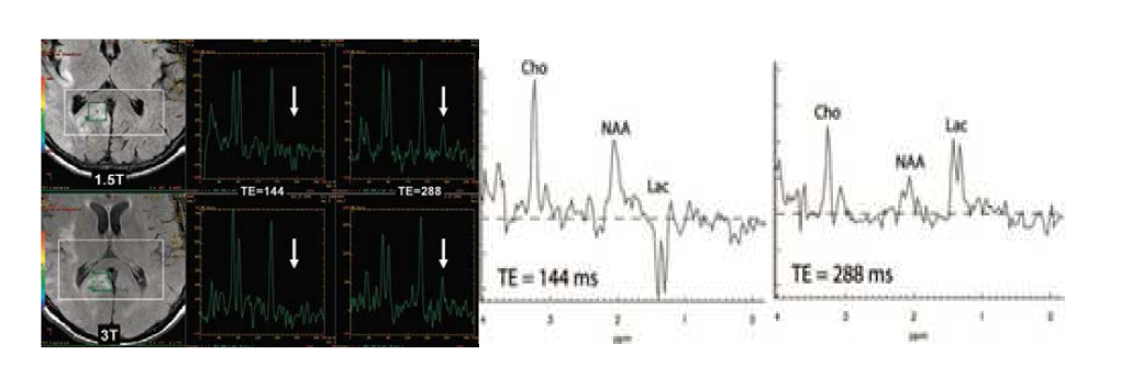 뇌종양 환자의 병변 부위에서 MRS 기법을 이용한 lactate 정량화 시 자기공명기의 자기장의 세기에 따른 기술적 어려움 (좌). MRS를 이용한 lactate 정량화 예 (lactate 신호와 젓첩되는 지방으로 부터의 신호를 제거하기 위한 기술로써 두 데이터를 차감하면 lactate 신호는 두배가 되는 반면 지방신호는 제거가 되는 소위 difference spectra 방법의 예 (우).