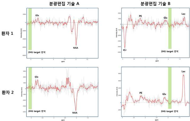 2HG 신호 검출을 위해 특이적으로 개발된 분광편집 기술 A와 B를 활용하여 뇌종양 환자의 종양 부위에서 비침습적으로 얻어진 스펙트럼의 예.