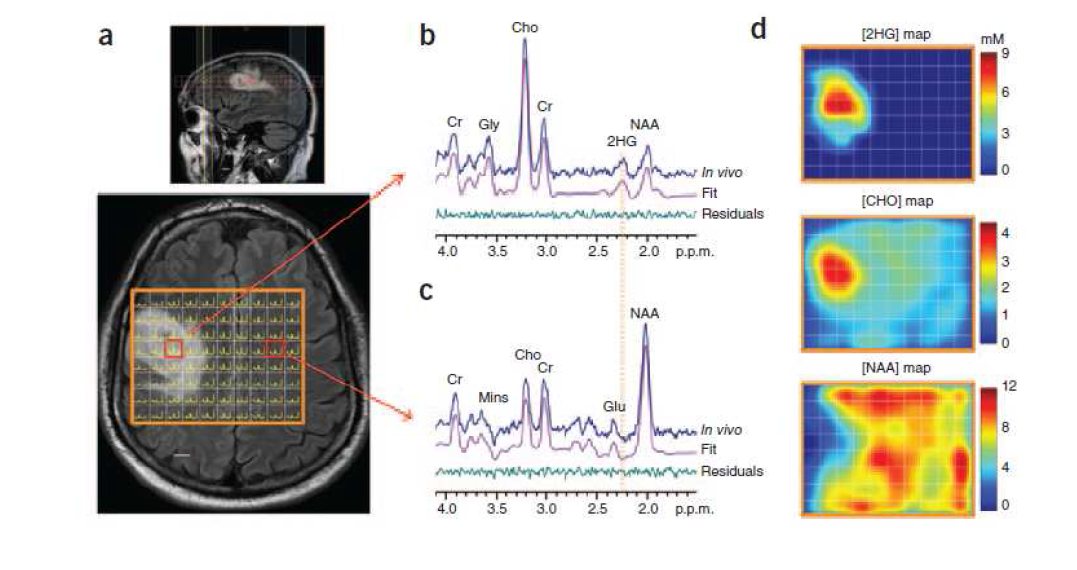 MRS를 이용한 IDH1 변이 뇌교종 환자에서 2-HG 측정 (Choi et al., Nature Medicine,