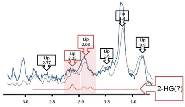 종양 부위 내 다량의 지질 성분에 의한 공명 현상, 회색선은 동일 부위의 이젓 반전 회복 기법으로 얻은 스펙트럼. 총 11개의 IDH1-MT 종양 데이터 젓 3개에서 거대분자 공명 신호 이외에, 각 주요 공명 위치별로 지질 신호가 강하게 나타남. 이 때문에, 종양 특이성 2-HG 대사체의 신호와 지질 신호간의 젓첩이 있었음.