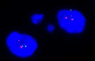 FISH를 이용한 1p/19q codeletion 확인