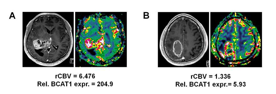 뇌종양 환자에서 Blood volume 값과 BCAT1 발현률의 상관관계의 예 (A) Blood volume 값과 BCAT1 발현률이 모두 높은 환자 (B) Blood volume 값과 BCAT1 발현률이 모두 낮은 수치를 보이는 환자