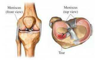 반월상 연골판(meniscus)은 관절연골(cartilage)과 관절연골이 만나는 그 사이에 위치하는 C자형 구조물로서 관절연골의 충격 흡수를 돕고, 관절염을 예방하는 기능을 함.