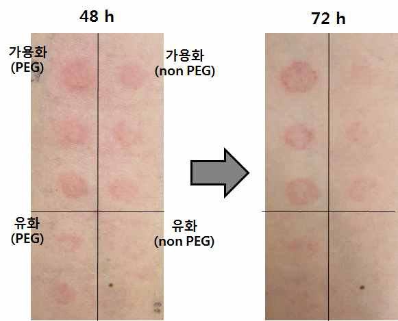 피험자(Sub. No. 4)의 Patch test 후 피부 사진