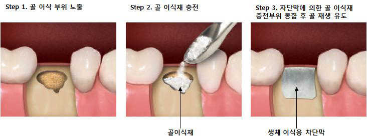 임플란트 식립을 위한 골 유도 재생술