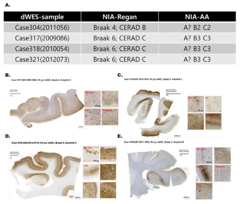 알츠하이머 환자의 병리단계 정보 및 면역조직화학법을 통한 신경섬유매듭(NFT) 존재 및 분포 확인결과