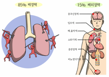 결핵의 종류의 빈도