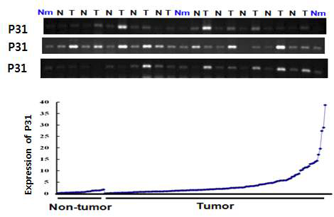 암 주변조직, 암 조직에서의 P31 발현 양상