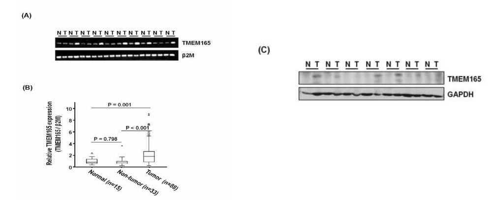 TMEM165는 간암조직에서 과발현
