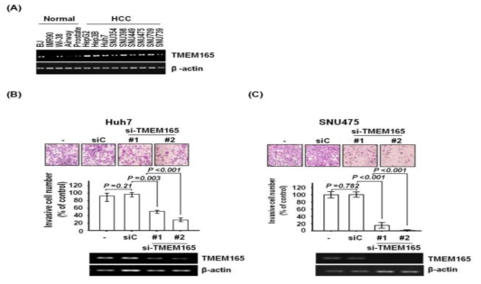 TMEM165는 간암세포에서 과발현되어 있고 암 친윤과 관련이 있음