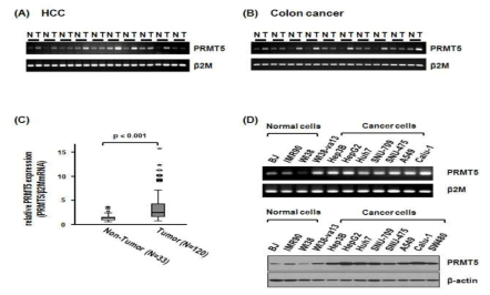 PRMT5는 간암 그리고 대장암에서 과발현 되어있음