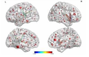 제안한 방법의 Brain connectivity 분석 결과 (FDP=0.1 제어하에서 4005개의 잠재적 연결 중에 17개의 significant한 뇌연결성을 찾아냄).