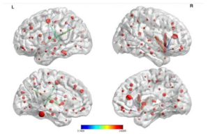 제안한 방법의 Brain connectivity 분석 결과(FDP=0.1 제어하에서 4005개의 잠재적 연결 중에 17개의 significant한 뇌연결성을 찾아냄).