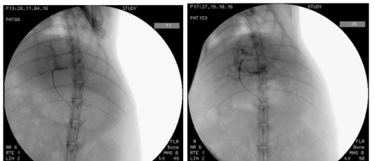 Catheter를 이용한 Tc-99m-HED 주입 시 angiography 영상