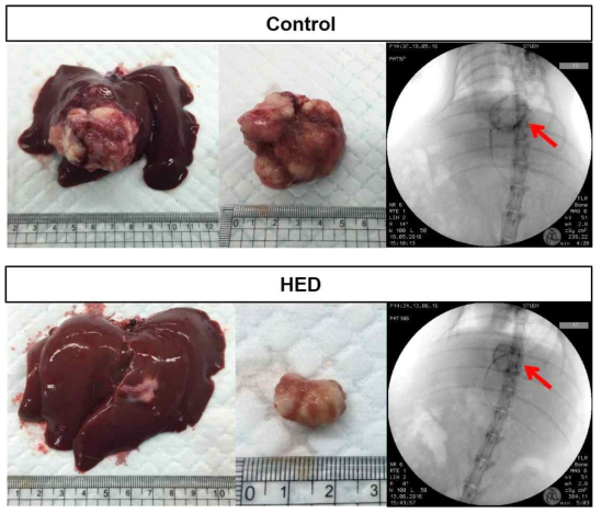 대조군과 HED 처리 2주 후 angiography 영상 (우측)과 간 적출(좌측), 분리한 종양 (중앙)의 사진.