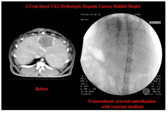 2.5 cm의 치료전 CT 영상과 조영제를 이용한 카테터 간동맥 색전술의 angiography 영상