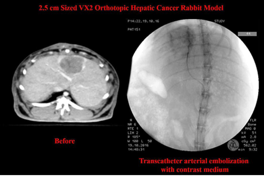 2.5 cm의 치료전 CT 영상과 조영제를 이용한 카테터 간동맥 색전술의 angiography 영상