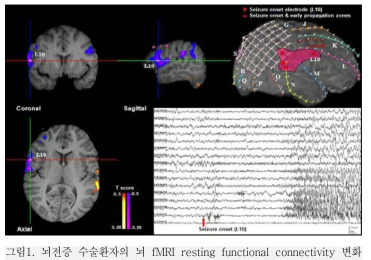 뇌전증 수술환자의 뇌 fMRI resting functional connectivity 변화 부위가 두개강내 뇌파상 경련발작파 발생부위와 잘 일치함을 보여줌.