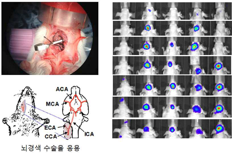 뇌경색수술법(왼쪽)을 응용한 유방암 뇌전이 모델(오른쪽).