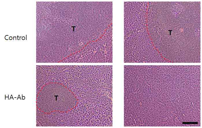 HA(hyaluronic acid)에 modify된 DR-5 (death receptor-5) Antibody (Ab)를 정맥주사 한 마우스의 간을 조직염색하였을 때 관찰된 간전이 (T) 정도.