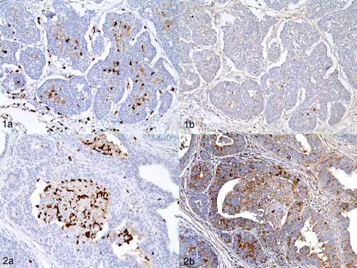 Figure 1a : 정상 개체에서의 macrophage 발현, 1b: 정 상 개체에서의 1a와 동일 부위에서의 cd163 발현 Figure 2a : 비만 개체에서의 macrophage 발현, 2b: 비 만 개체에서의 2a와 동일 부위에서의 cd163 발현