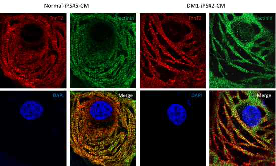 DM1 질환 특이적인 abnormal sarcomere formation