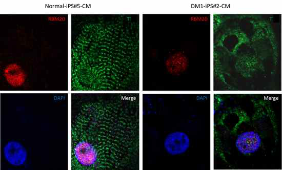 DM1 질환 특이적인 T 단백질 발현 억제 확인