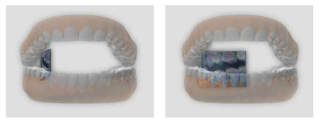 치과 촬영 시 사용되는 평판형 검출기(좌)와 휨성 검출기(우)의 비교 모식도