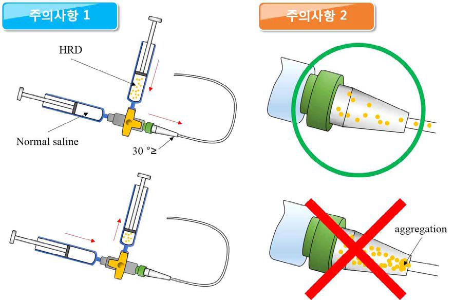 catheter-connected infusion system 수행시 주의사항