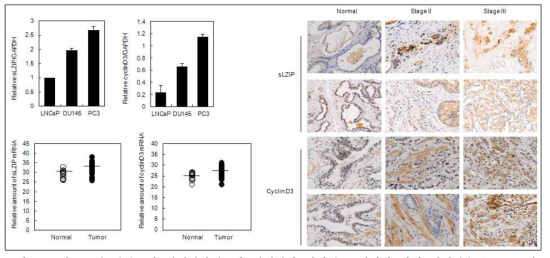 안드로겐 비의존적 전립선암세포와 전립선암 환자의 조직에서 암이 진행될수록 sLZIP과 cyclin D3의 발현량이 증가함.
