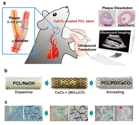 CaCO3를 코팅한 스텐트로 초음파 미세기포를 만들고 이를 이용한 치료시스템.