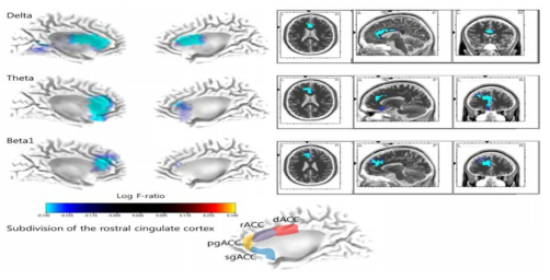 연구 결과 요약: 이명의 지각 시간과 음의 상관관계를 갖는 대뇌 영역