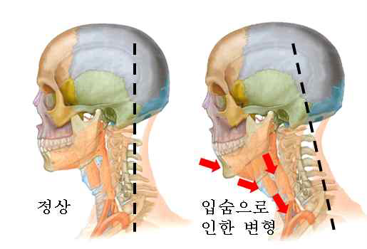 입숨으로 인한 턱, 척추 형태의 변화