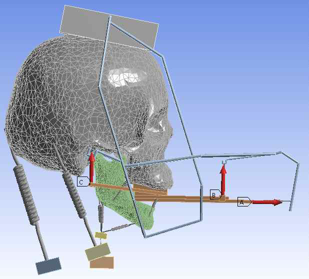 구강외 장치의 두개골 적용 시뮬레이션