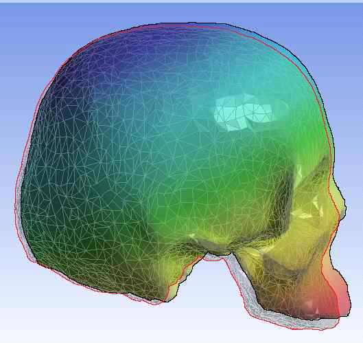 상악 두개골 변형 시뮬레이션