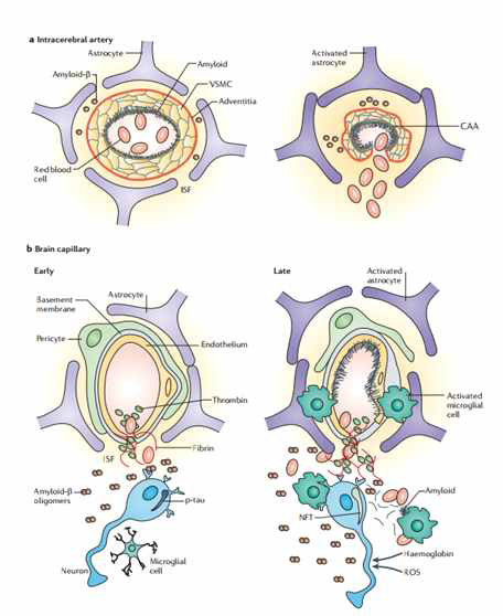혈관 손상에 의한 알쯔하이머병 발생 기전 가설
