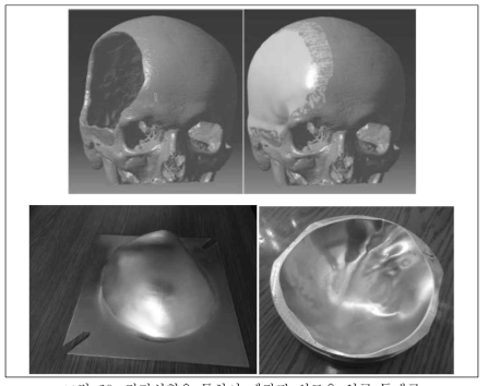 점진성형을 통하여 제작된 의료용 인공 두개골