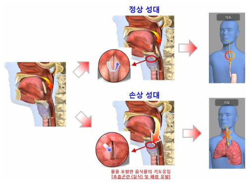 성대 손상에 의한 호흡곤란(질식) 및 폐렴 유발 모식도.