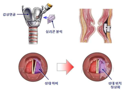 갑상성형술에 의한 성대위축/음성장애 처치 모식도