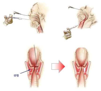 성대주입술에 의한 성대위축/음성장애 처치 모식도