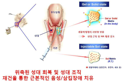 본 과제의 생물학 제제 탑재 고분자 주사제의 성대 주입에 의한 성대손상 장애 (음성/삼킴 장애) 치료 모식도