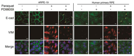 산화스트레스에 따른 망막상피세포주 (ARPE-19, human primary RPE)의 상피-간엽세포화 진 행과 ERK 억제제인 PD98059에 의한 상피-간엽세포화 저해