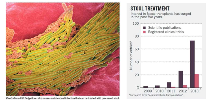 Clostridium difficile (노란색) 전자현미경 사진 및 대변이식 관련 논문 및 임상시도 증대