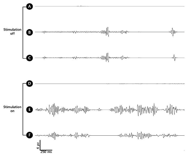 Photic Stimulation off 시 (上), on 시 (下). 두 환경에서 확연히 다른 뇌파를 보이며, 등뼈에 위치한 A와 D는 photic stimulation에 반응하지 않는 것 을 알 수 있다.