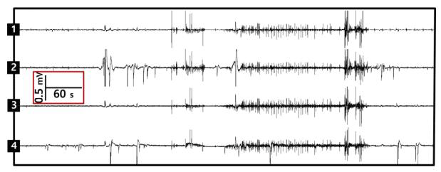 PTZ 주입 후 발현된 제브라피쉬에서의 비정상적 뇌파 활동. 정상적인 뇌파와 확연히 비교 되는 신호가 확인된다.