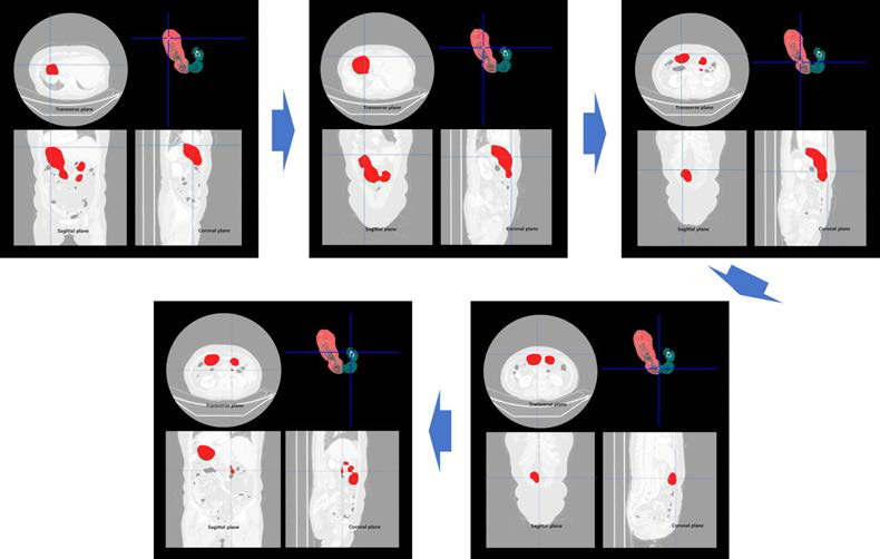 3D 랜더링을 한 위장 맵에서의 네비게이션과 위장 맵에서의 좌표 값이 나타내는 2D 상 CT 이미지