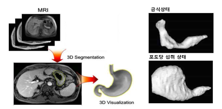 MRI 영상추출 기반 3D 모델링 방법(왼쪽)과 실제 MRI에서 얻은 위장의 3D 모델 (오른쪽)